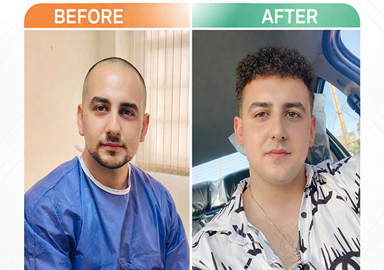 کاشت مو سیما ابراهیمی